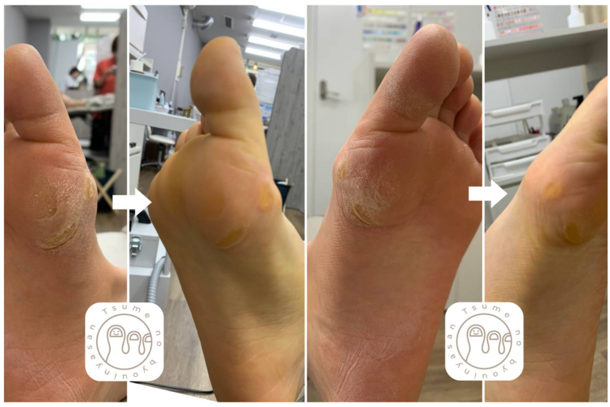 足裏の角質ケア