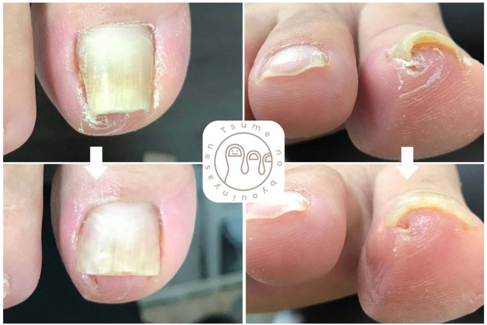 痛くない！巻き爪補正